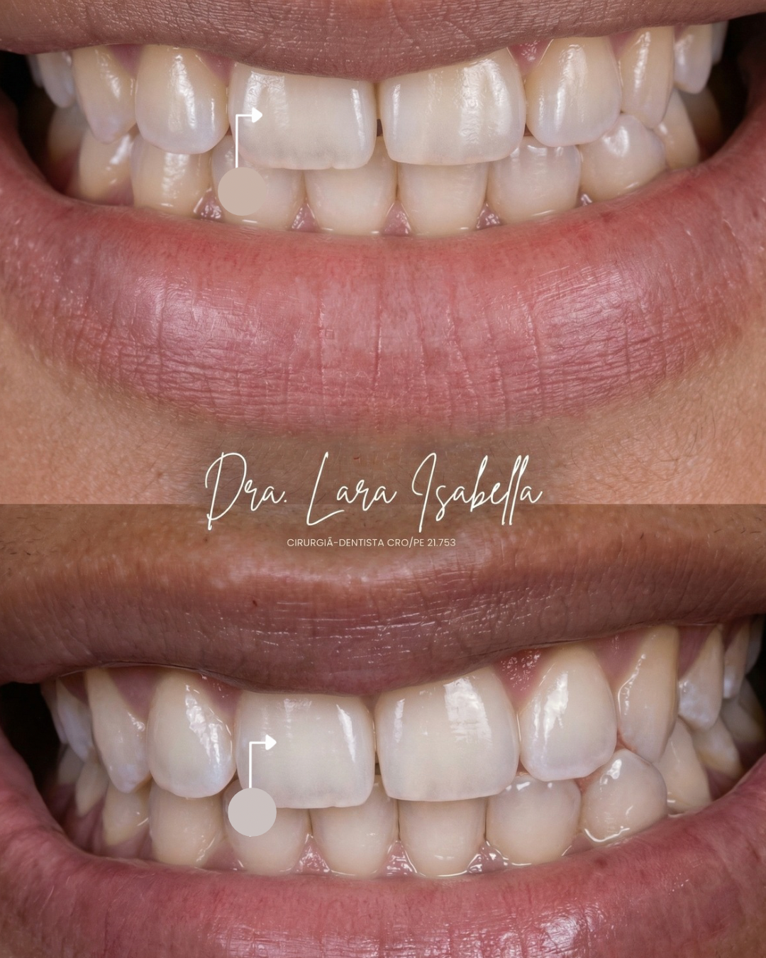 Resultado de acréscimos em resina em detalhe do sorriso