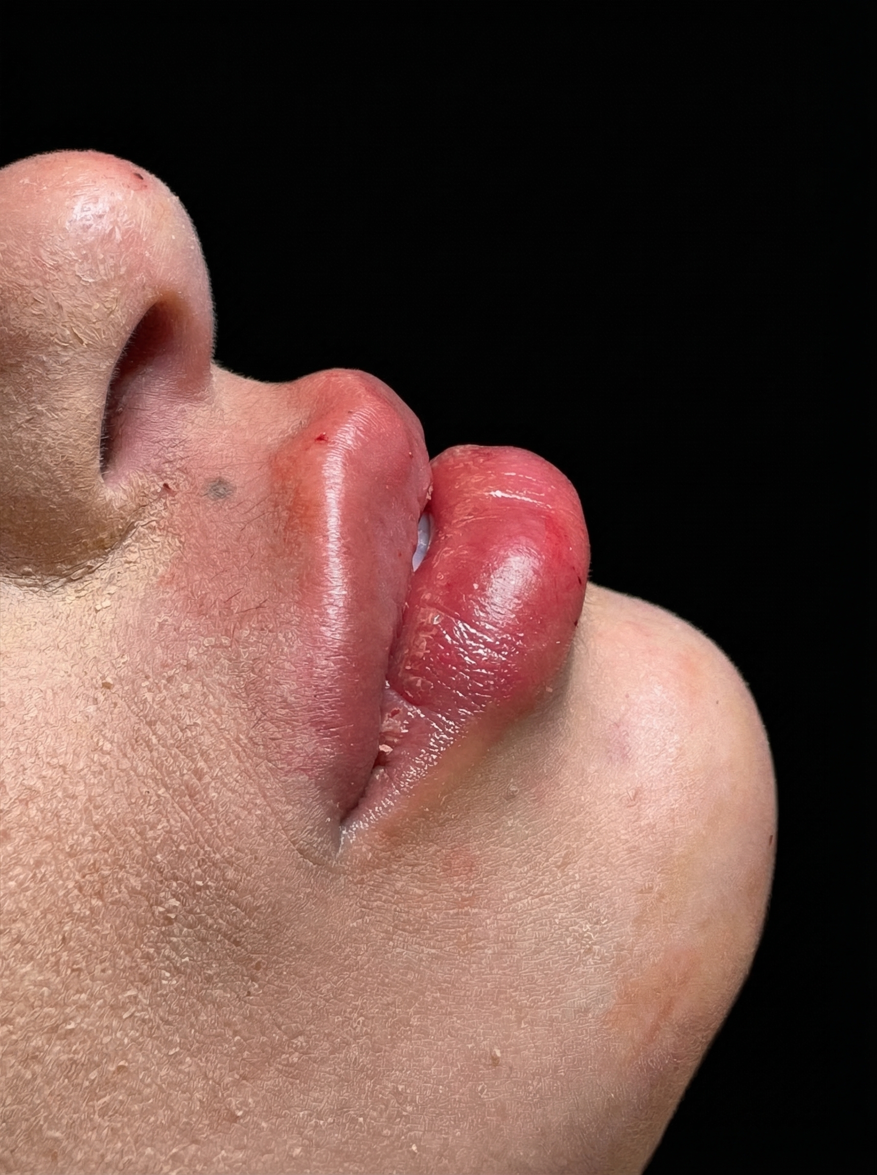 Resultado de preenchimento labial em detalhe lateral